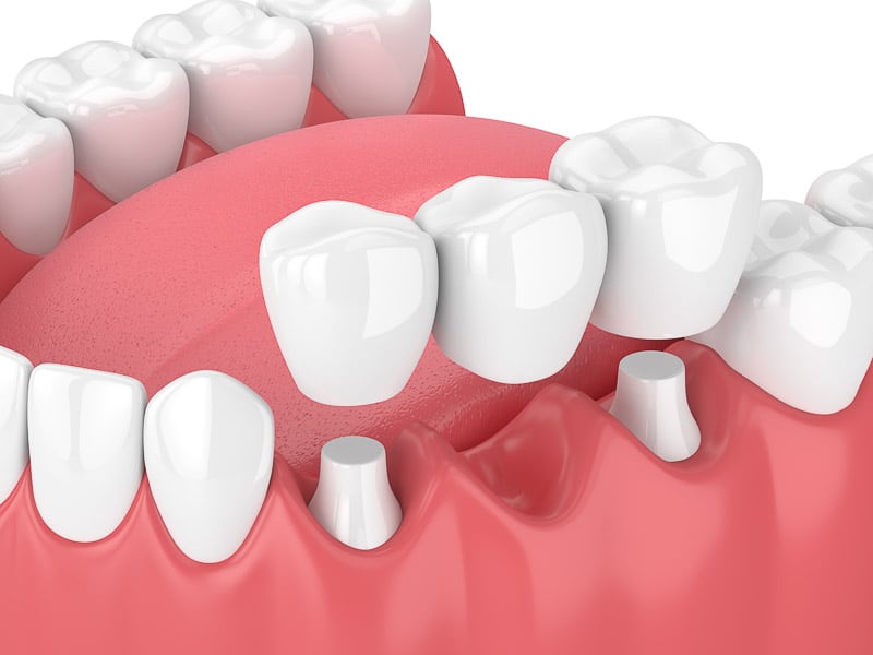 Dental Bridges-Brewer Family Dental, Orange, TX