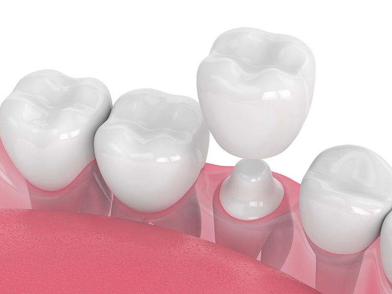 Dental Crowns-Brewer Family Dental, Orange, TX