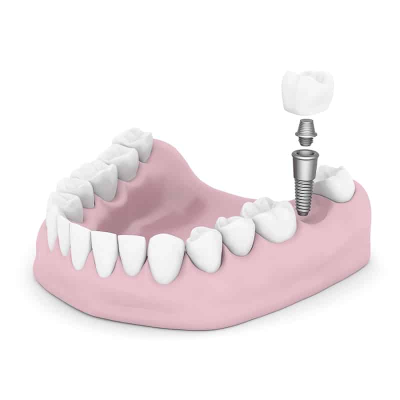 Dental implants