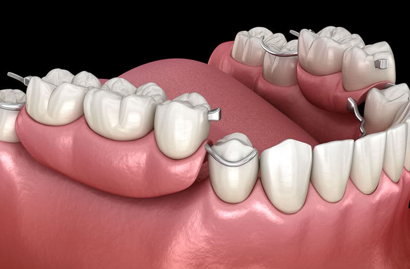 Removable partial dentures-Brewer Family Dental, Orange, TX