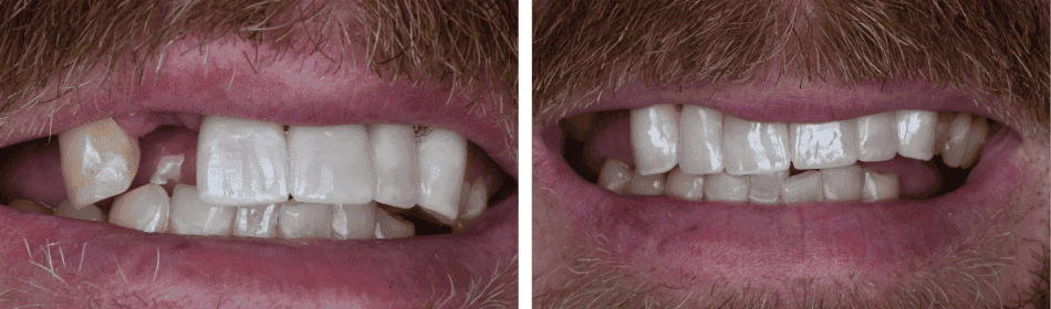 Anterior Crowns before and after
