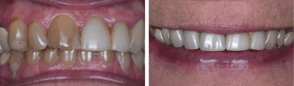 Anterior Crowns before and after