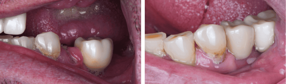 Implant crown before & after