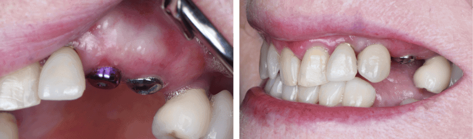 Implant Crown Before After