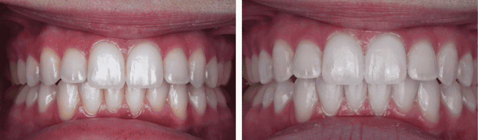 Teeth Whitening Before & After
