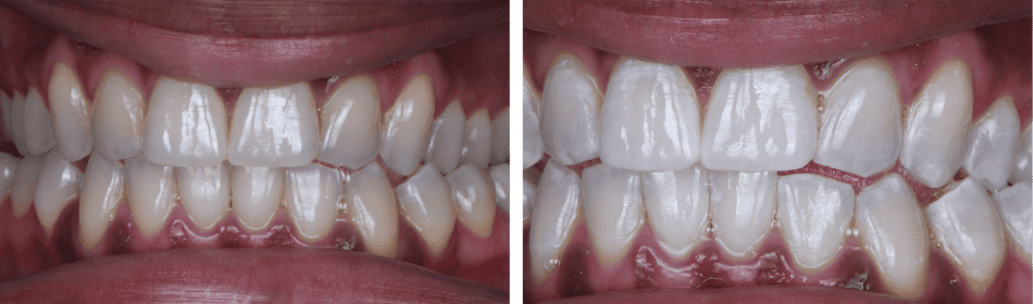 Teeth Whitening Before & After