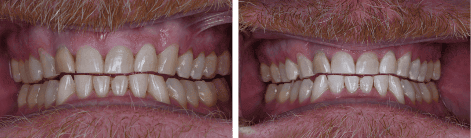 Teeth Whitening