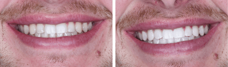 Zoom Teeth Whitening Before & After